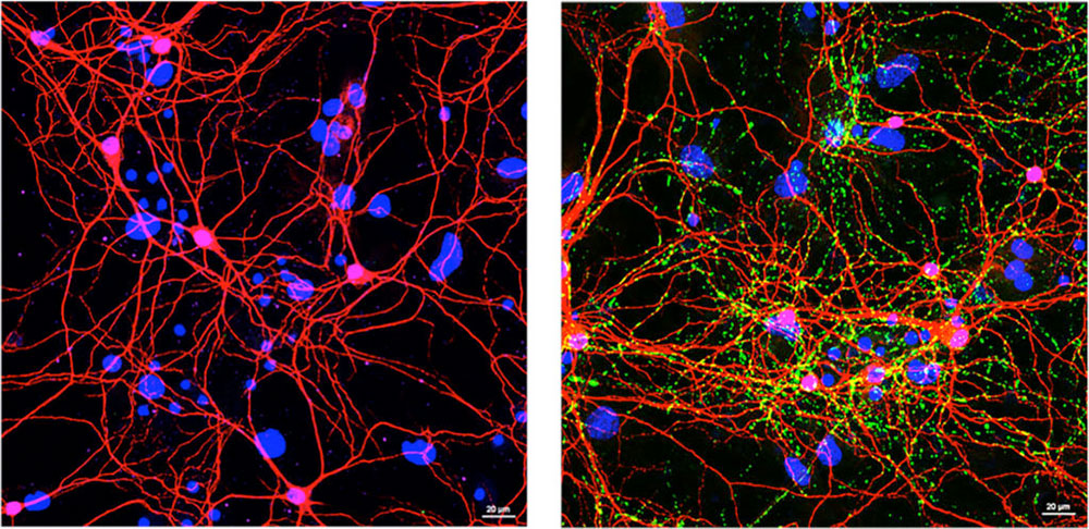 Left, imaging of healthy neurons from mouse brain. Right, imaging of damaged neurons by PD protein clumps.