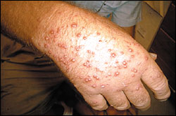 Fire ant stings on hand