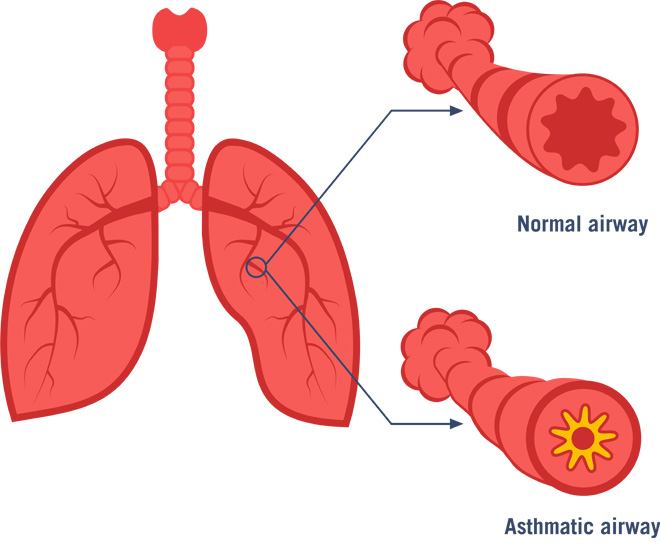 Comparison of normal and asthmatic airways. The asthmatic airway is constricted.