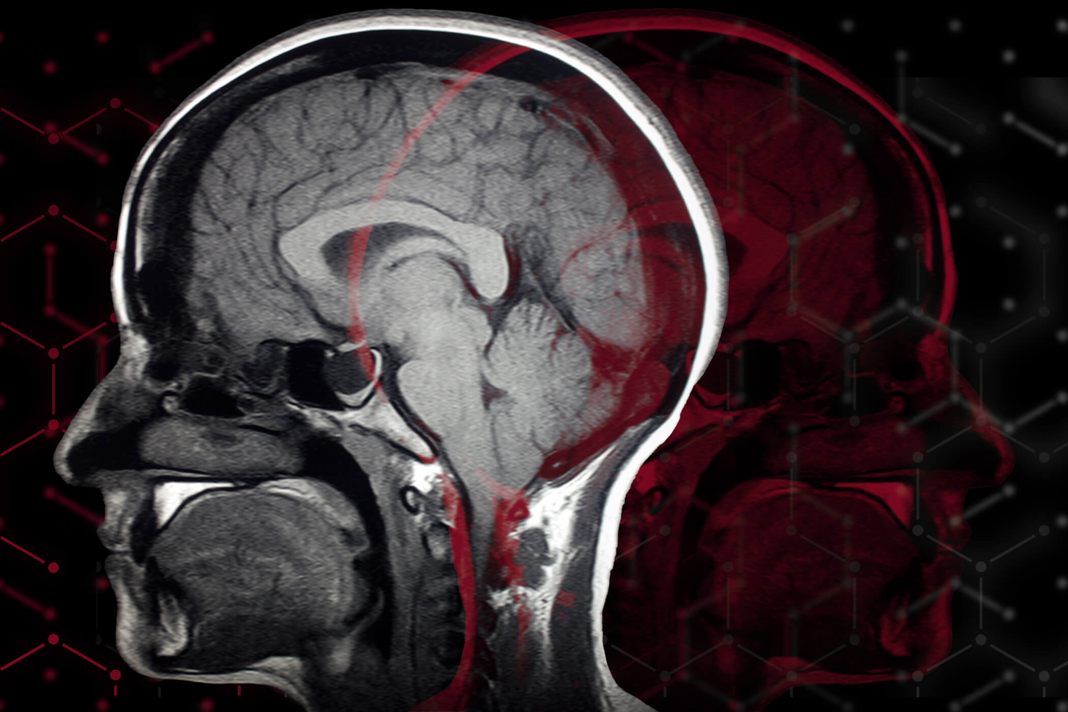 TBI Treatment