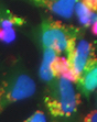 Neural stem cells are expressing green fluorescent protein and labeled with the iron beads that are red in color.