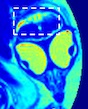 This photo represents pseudo-colored MRI T1 maps of a Zika-infected chicken embryo. The embryo was infected with the Zika virus at a time associated with the first trimester of a human pregnancy. The photo captures a well-developed chicken embryo within the egg, and lesion within the brain, attributed to the Zika virus infection.