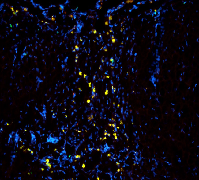 The picture represents the sustained presence of labeled neural stem cells (NSCs) within the 'Brain Glue' construct four weeks after a severe Traumatic Brain Injury (TBI), according to University of Georgia scientist Lohitash Karumbaiah who led the team that designed and created Brain Glue. The construct laden with labeled NSCs was delivered directly into the lesion 48 hours post-TBI.
